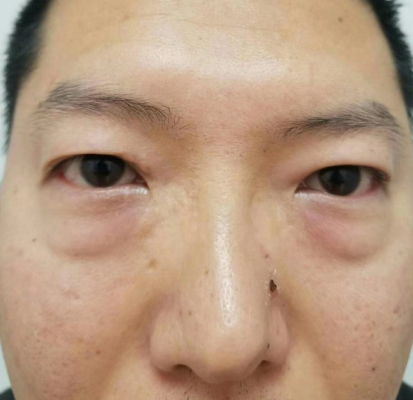 去眼袋手术