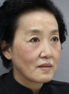 去眼袋手术