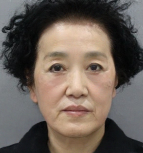 去眼袋手术