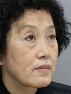 去眼袋手术
