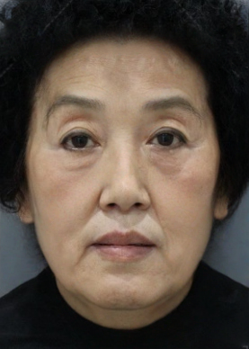去眼袋手术