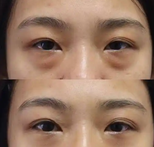 去眼袋手术