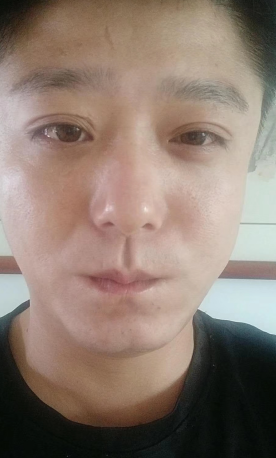 眼袋