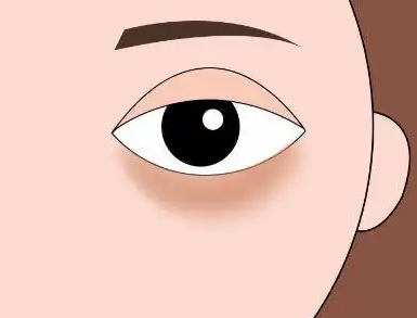 眼袋