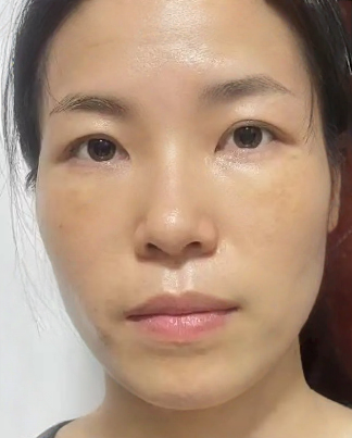 去眼袋手术