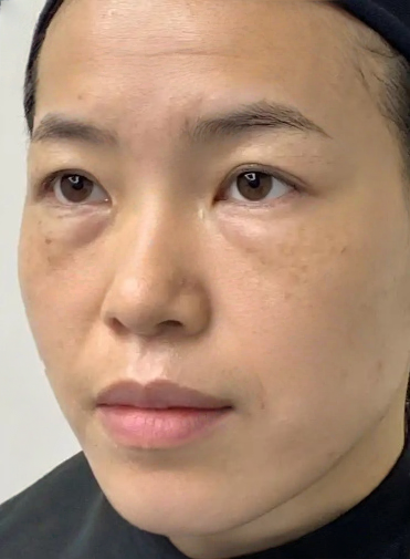 去眼袋手术