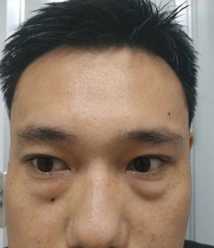 去眼袋手术
