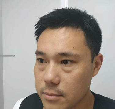 去眼袋手术