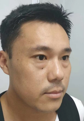 去眼袋手术