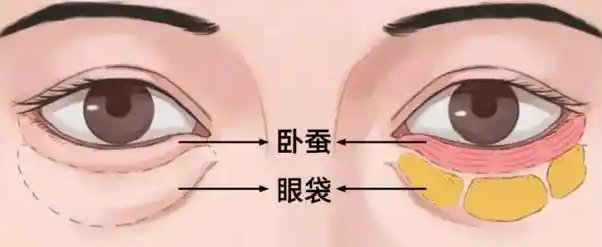 去眼袋手术