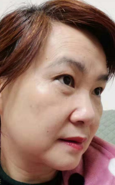 去眼袋手术