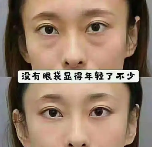 去眼袋手术