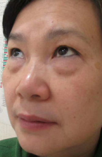 去眼袋手术
