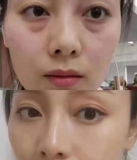 去眼袋手术