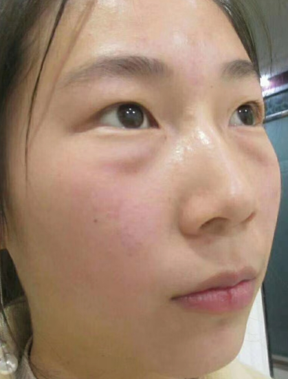 去眼袋手术