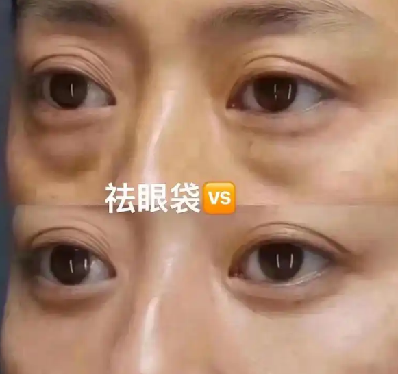 去眼袋手术