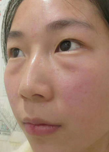 去眼袋手术