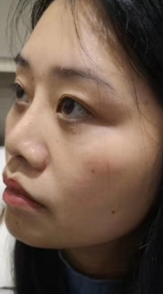 去眼袋手术