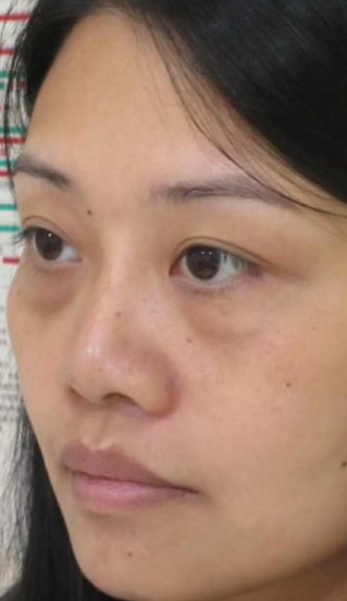 去眼袋手术