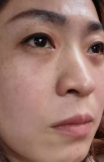 去眼袋手术