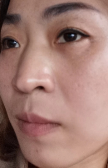 去眼袋手术