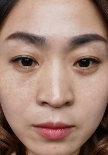 去眼袋手术