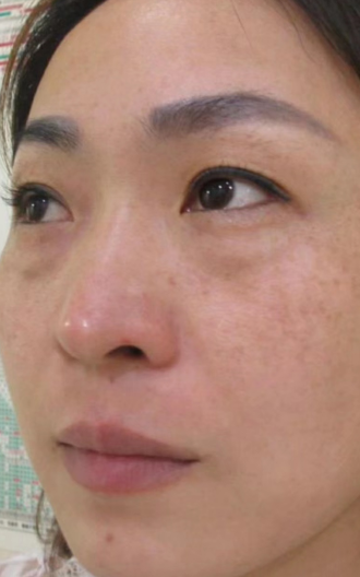 去眼袋手术