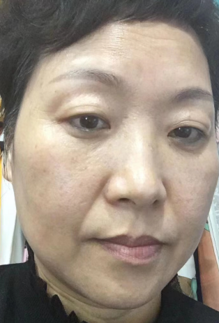 去眼袋手术
