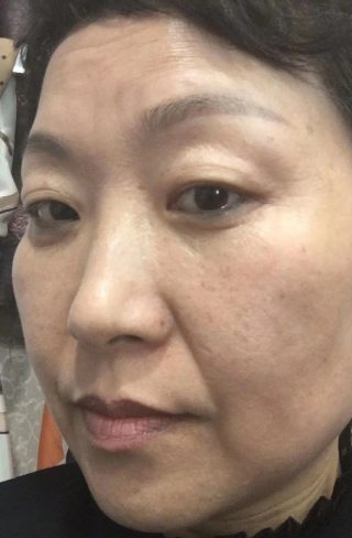 去眼袋手术