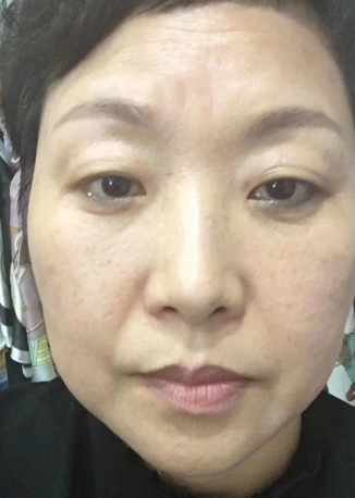 去眼袋手术