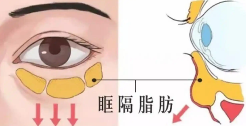 去眼袋手术