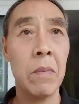 去眼袋手术