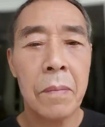 去眼袋手术