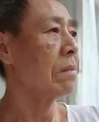 去眼袋手术