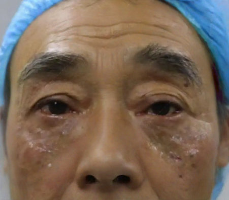 去眼袋手术