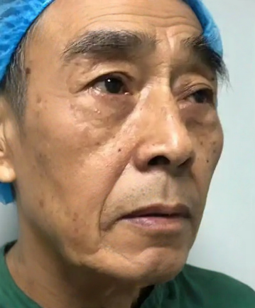 去眼袋手术