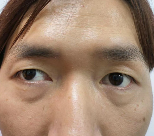 去眼袋手术