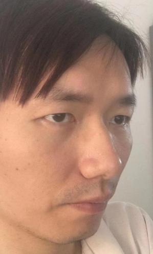 去眼袋手术