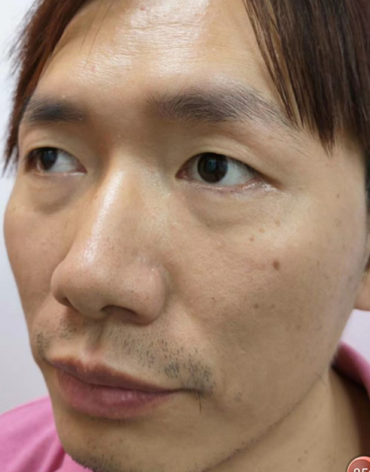 去眼袋手术