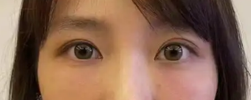 去眼袋手术