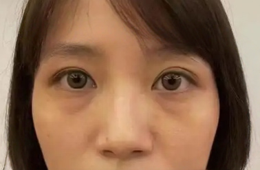 去眼袋手术