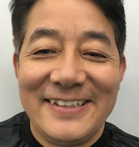 去眼袋手术
