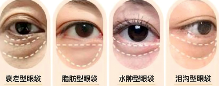 去眼袋手术