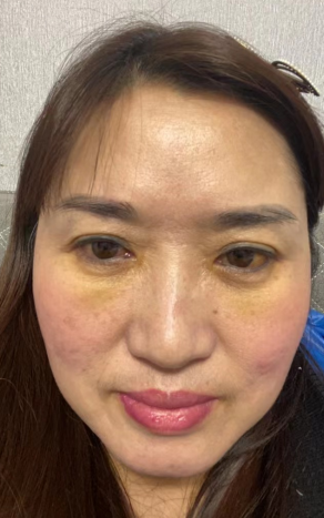 去眼袋手术