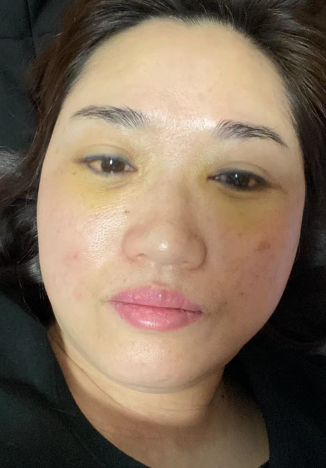 去眼袋手术