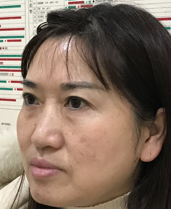 去眼袋手术