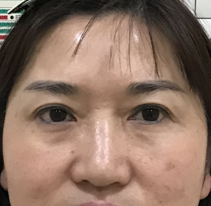 去眼袋手术