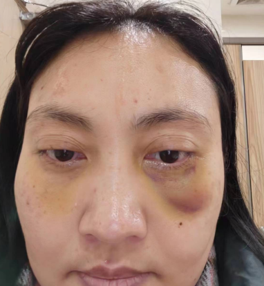 去眼袋手术