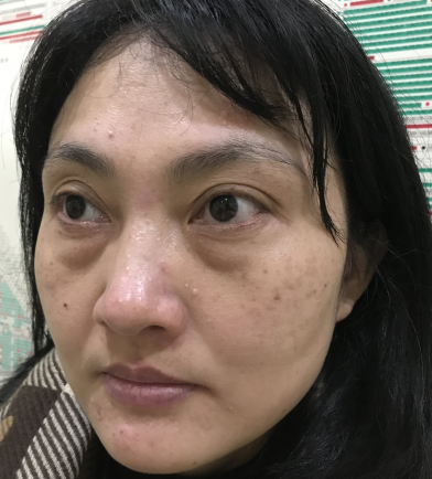 去眼袋手术