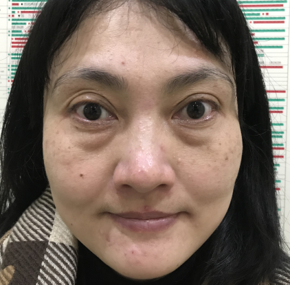 去眼袋手术